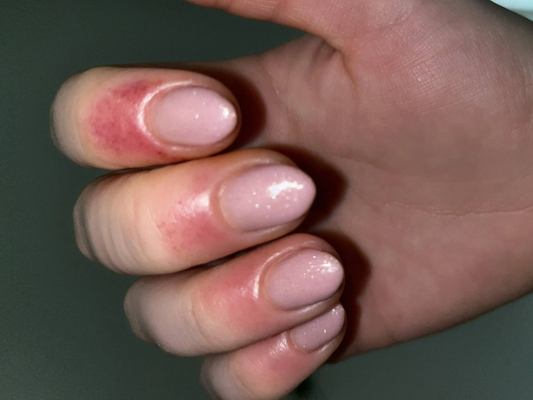 Gel Polish Allergy: What Is It and What Can You Do?