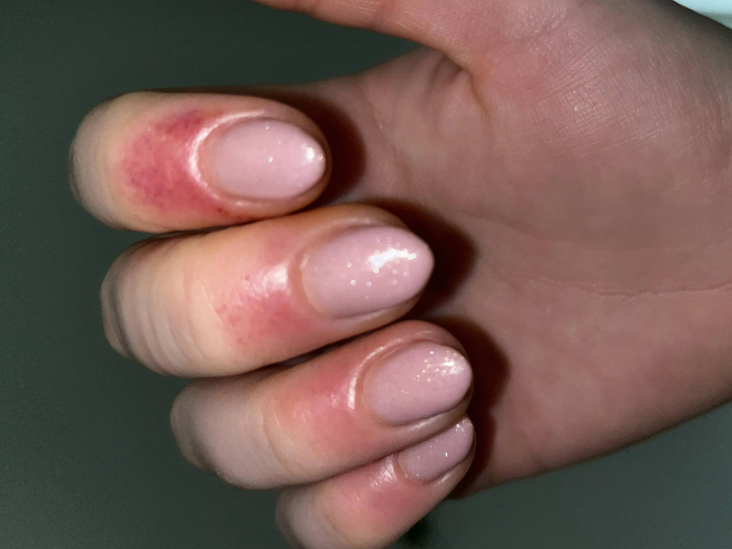 Gel Polish Allergy: What Is It and What Can You Do?